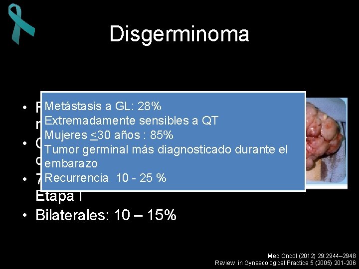Disgerminoma Metástasis a GL: • Representa 2 %28% de las Extremadamente sensibles a QT