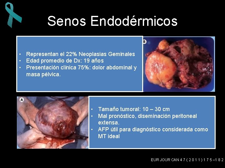 Senos Endodérmicos • Representan el 22% Neoplasias Geminales • Edad promedio de Dx: 19