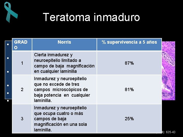 Teratoma inmaduro GRAD Norris • Derivado de las 3 capas O germinales Cierta inmadurez