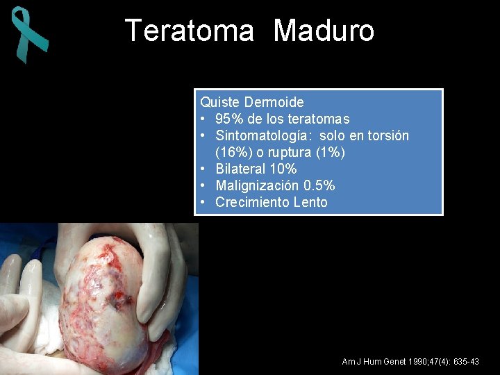 Teratoma Maduro Quiste Dermoide • 95% de los teratomas • Sintomatología: solo en torsión