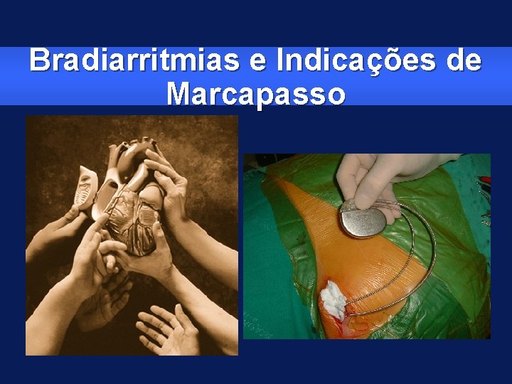 Bradiarritmias e Indicações de Marcapasso 