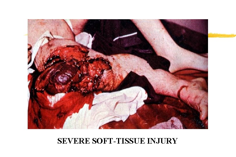 SEVERE SOFT-TISSUE INJURY SEVERE SOFT-TISSUE INJURY