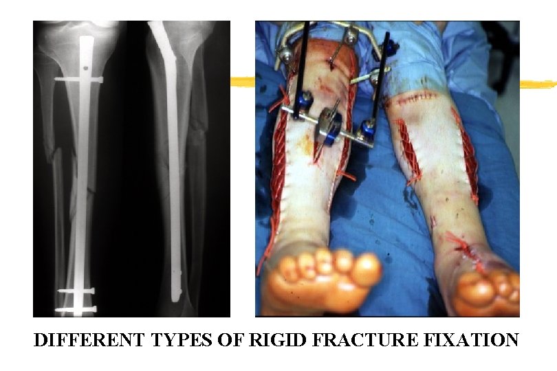 DIFFERENT TYPES OF RIGID FRACTURE FIXATION DIFFERENT TYPES OF RIGID FRACTURE FIXATION