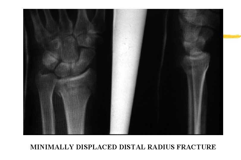 MINIMALLY DISPLACED DISTAL RADIUS FRACTURE MINIMALLY DISPLACED DISTAL RADIUS FRACTURE