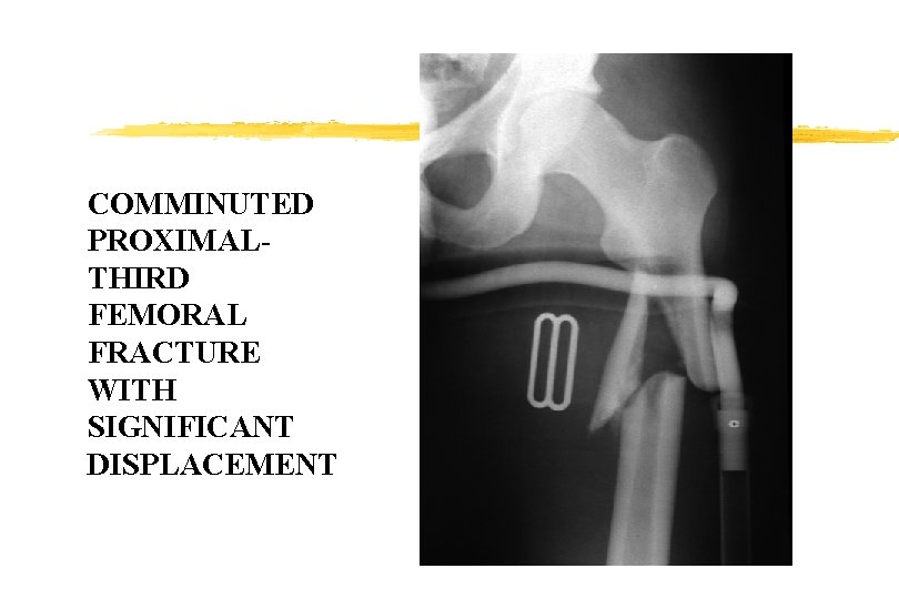 COMMINUTED PROXIMALTHIRD FEMORAL FRACTURE WITH SIGNIFICANT DISPLACEMENT COMMINUTED PROXIMALTHIRD FEMORAL FRACTURE WITH SIGNIFICANT DISPLACEMENT