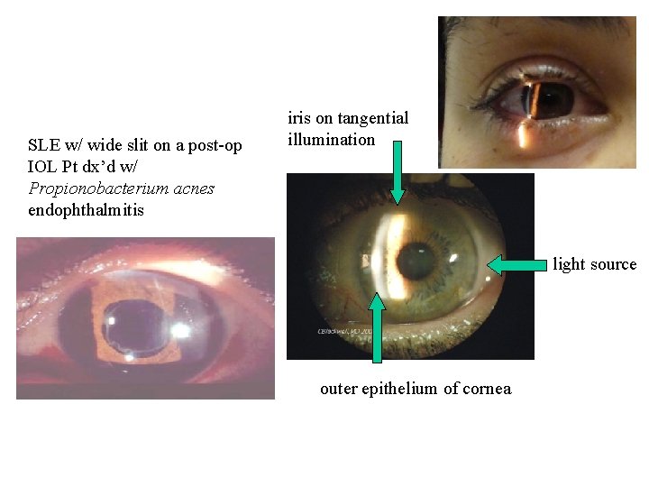 SLE w/ wide slit on a post-op IOL Pt dx’d w/ Propionobacterium acnes endophthalmitis