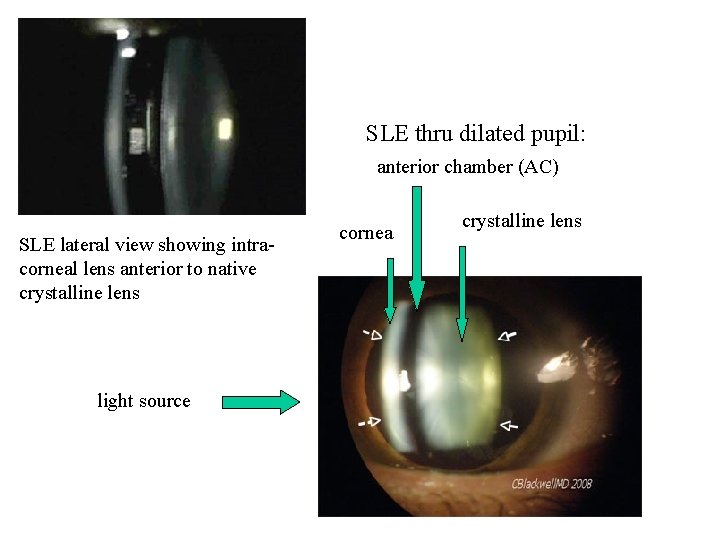 SLE thru dilated pupil: anterior chamber (AC) SLE lateral view showing intracorneal lens anterior