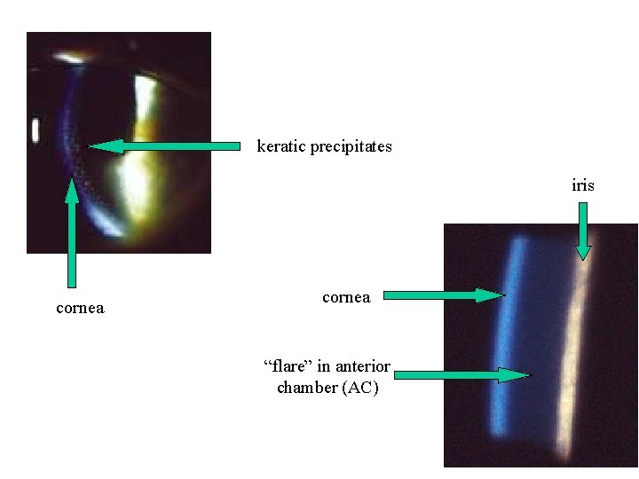 keratic precipitates iris cornea “flare” in anterior chamber (AC) 