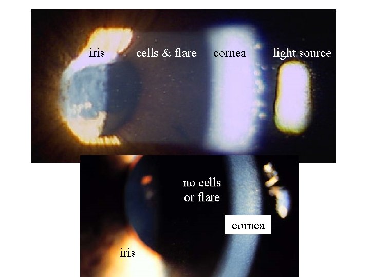 iris cells & flare cornea no cells or flare cornea iris light source 