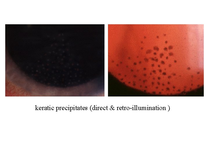 keratic precipitates (direct & retro-illumination ) 