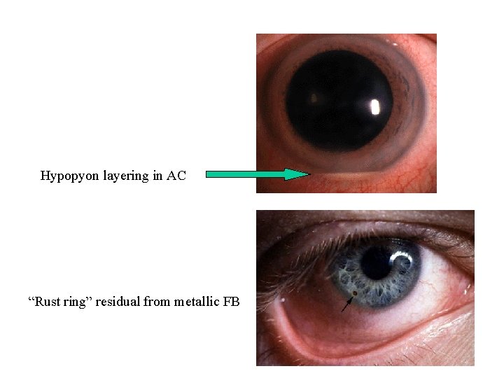 Hypopyon layering in AC “Rust ring” residual from metallic FB 