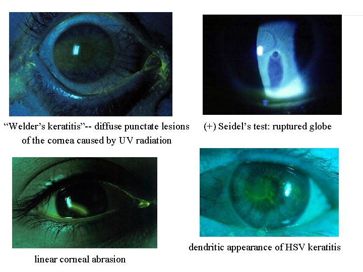 “Welder’s keratitis”-- diffuse punctate lesions of the cornea caused by UV radiation (+) Seidel’s