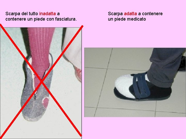 Scarpa del tutto inadatta a contenere un piede con fasciatura. Scarpa adatta a contenere