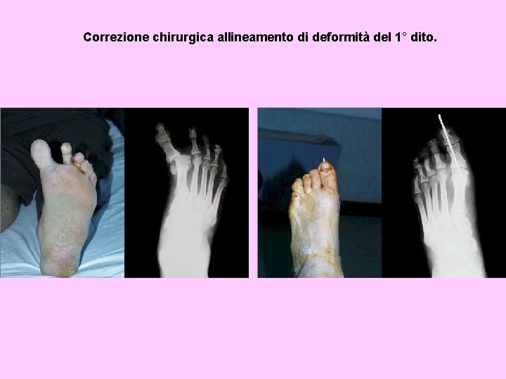 Correzione chirurgica allineamento di deformità del 1° dito. 