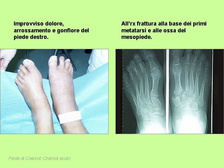 Improvviso dolore, arrossamento e gonfiore del piede destro. Piede di Charcot: Charcot acuto All’rx