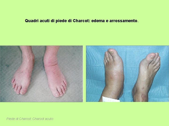 Quadri acuti di piede di Charcot: edema e arrossamento. Piede di Charcot: Charcot acuto