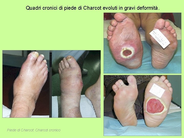 Quadri cronici di piede di Charcot evoluti in gravi deformità. Piede di Charcot: Charcot