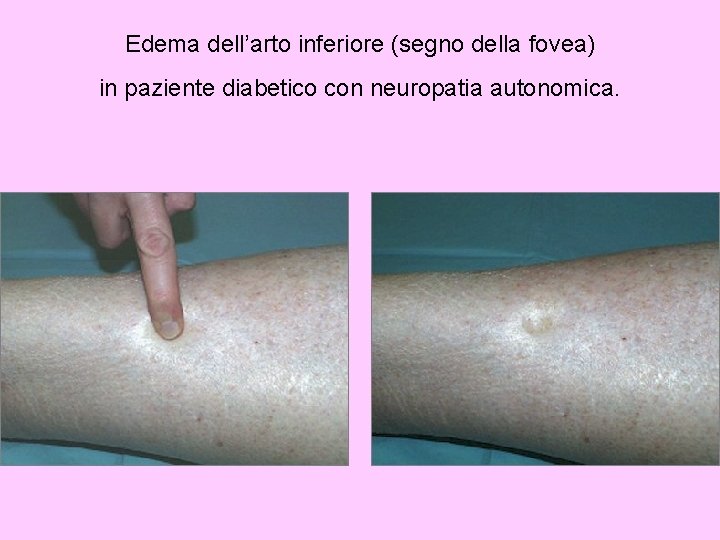 Edema dell’arto inferiore (segno della fovea) in paziente diabetico con neuropatia autonomica. 