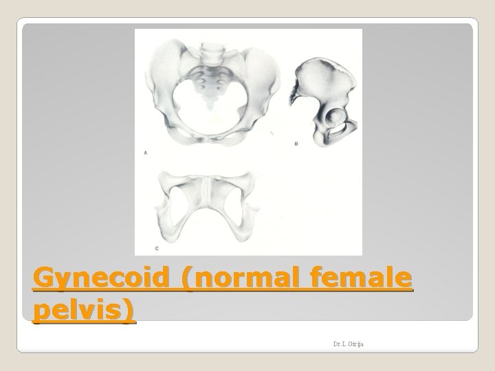 Gynecoid (normal female pelvis) Dr. L. Girija 
