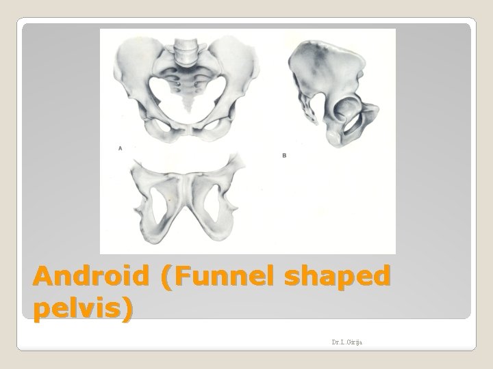 Android (Funnel shaped pelvis) Dr. L. Girija 