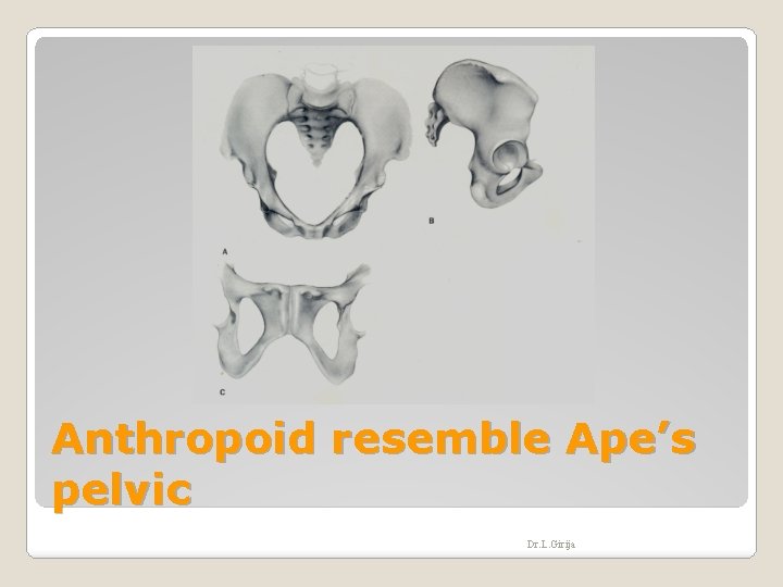 Anthropoid resemble Ape’s pelvic Dr. L. Girija Anthropoid resemble Ape’s pelvic Dr. L. Girija