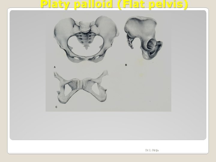 Platy palloid (Flat pelvis) Dr. L. Girija 