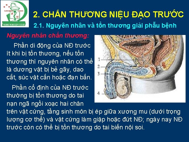 2. CHẤN THƯƠNG NIỆU ĐẠO TRƯỚC 2. 1. Nguyên nhân và tổn thương giải