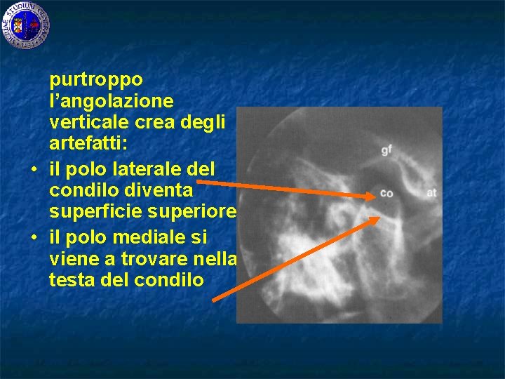 purtroppo l’angolazione verticale crea degli artefatti: • il polo laterale del condilo diventa superficie