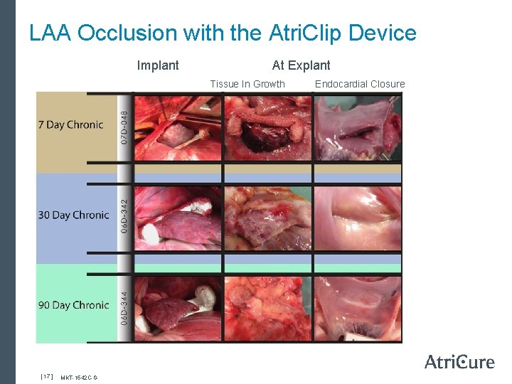 LAA Occlusion with the Atri. Clip Device Implant At Explant Tissue In Growth Endocardial