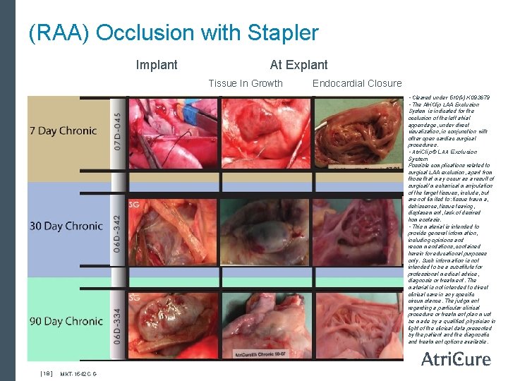 (RAA) Occlusion with Stapler Implant At Explant Tissue In Growth Endocardial Closure • Cleared