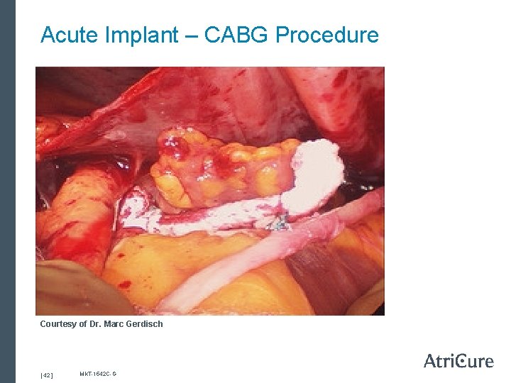 Acute Implant – CABG Procedure Courtesy of Dr. Marc Gerdisch [ 42 ] MKT-1542