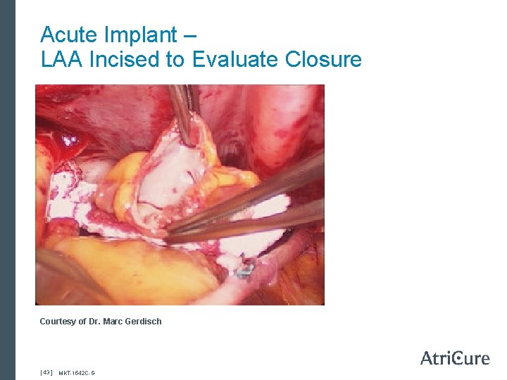 Acute Implant – LAA Incised to Evaluate Closure Courtesy of Dr. Marc Gerdisch [