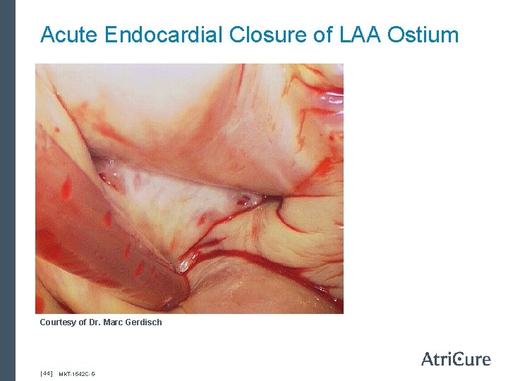 Acute Endocardial Closure of LAA Ostium Courtesy of Dr. Marc Gerdisch [ 44 ]