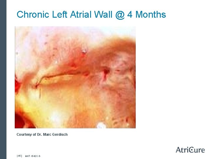 Chronic Left Atrial Wall @ 4 Months Courtesy of Dr. Marc Gerdisch [ 45