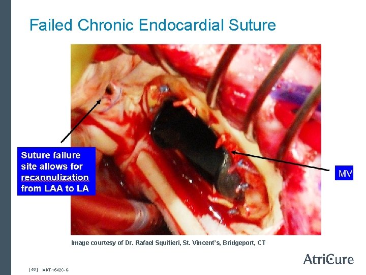 Failed Chronic Endocardial Suture Image courtesy of Dr. Rafael Squitieri, St. Vincent’s, Bridgeport, CT