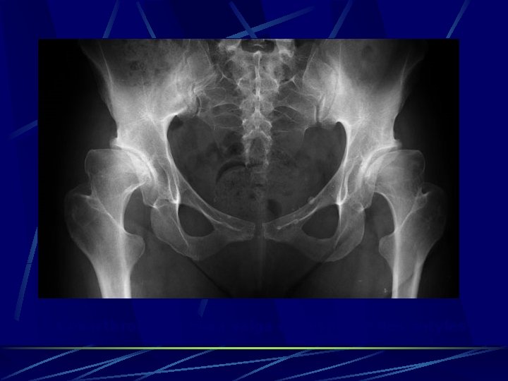 Coxarthrose sur coxa valga et dysplasie des cotyles 