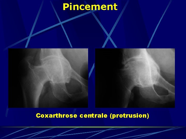 Pincement Coxarthrose centrale (protrusion) 