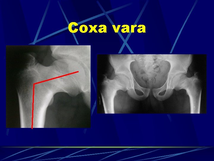 Coxa vara 