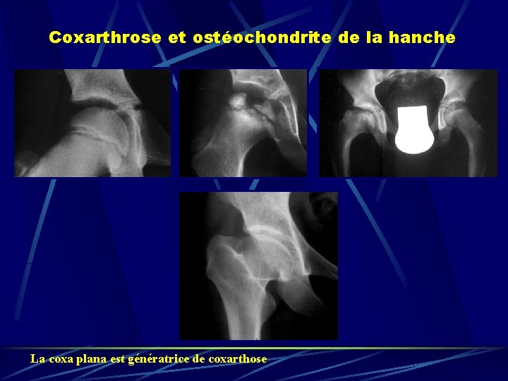 Coxarthrose et ostéochondrite de la hanche La coxa plana est génératrice de coxarthose 