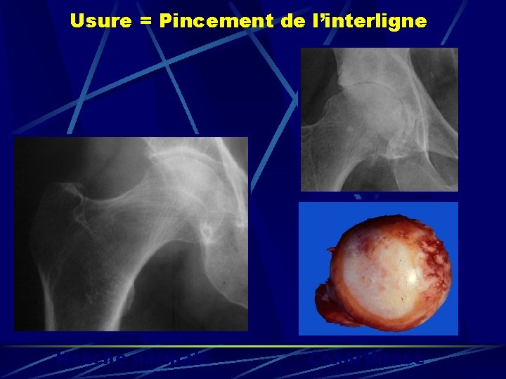 Usure = Pincement de l’interligne Hanche normale Coxarthrose 