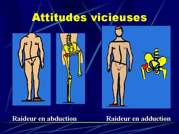 Attitudes vicieuses Raideur en abduction Raideur en adduction 