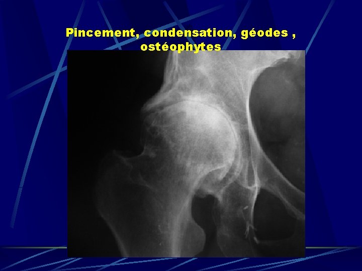 Pincement, condensation, géodes , ostéophytes 