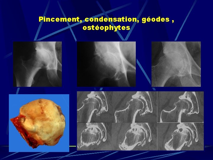 Pincement, condensation, géodes , ostéophytes 