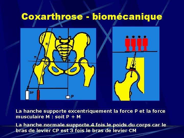 Coxarthrose - biomécanique La hanche supporte excentriquement la force P et la force musculaire