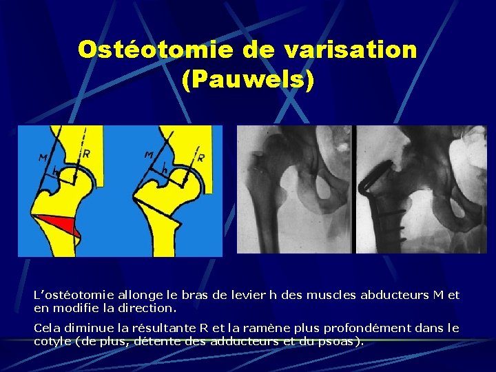 Ostéotomie de varisation (Pauwels) L’ostéotomie allonge le bras de levier h des muscles abducteurs