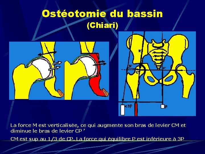 Ostéotomie du bassin (Chiari) Translation de la tête et couverture La force M est