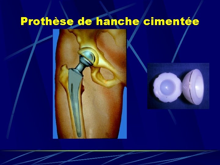 Prothèse de hanche cimentée 