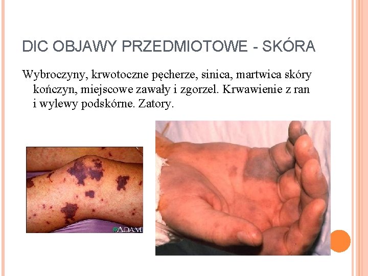 DIC OBJAWY PRZEDMIOTOWE - SKÓRA Wybroczyny, krwotoczne pęcherze, sinica, martwica skóry kończyn, miejscowe zawały DIC OBJAWY PRZEDMIOTOWE - SKÓRA Wybroczyny, krwotoczne pęcherze, sinica, martwica skóry kończyn, miejscowe zawały