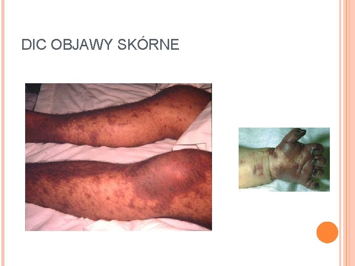 DIC OBJAWY SKÓRNE 