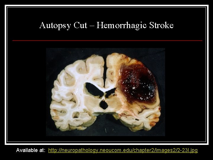 Autopsy Cut – Hemorrhagic Stroke Available at: http: //neuropathology. neoucom. edu/chapter 2/images 2/2 -23